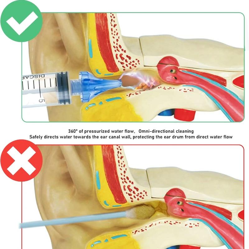 Seringues d'oreille pour bébé, 2 pièces, pour enlever la cire d'oreille, enfants et adultes, Irrigat