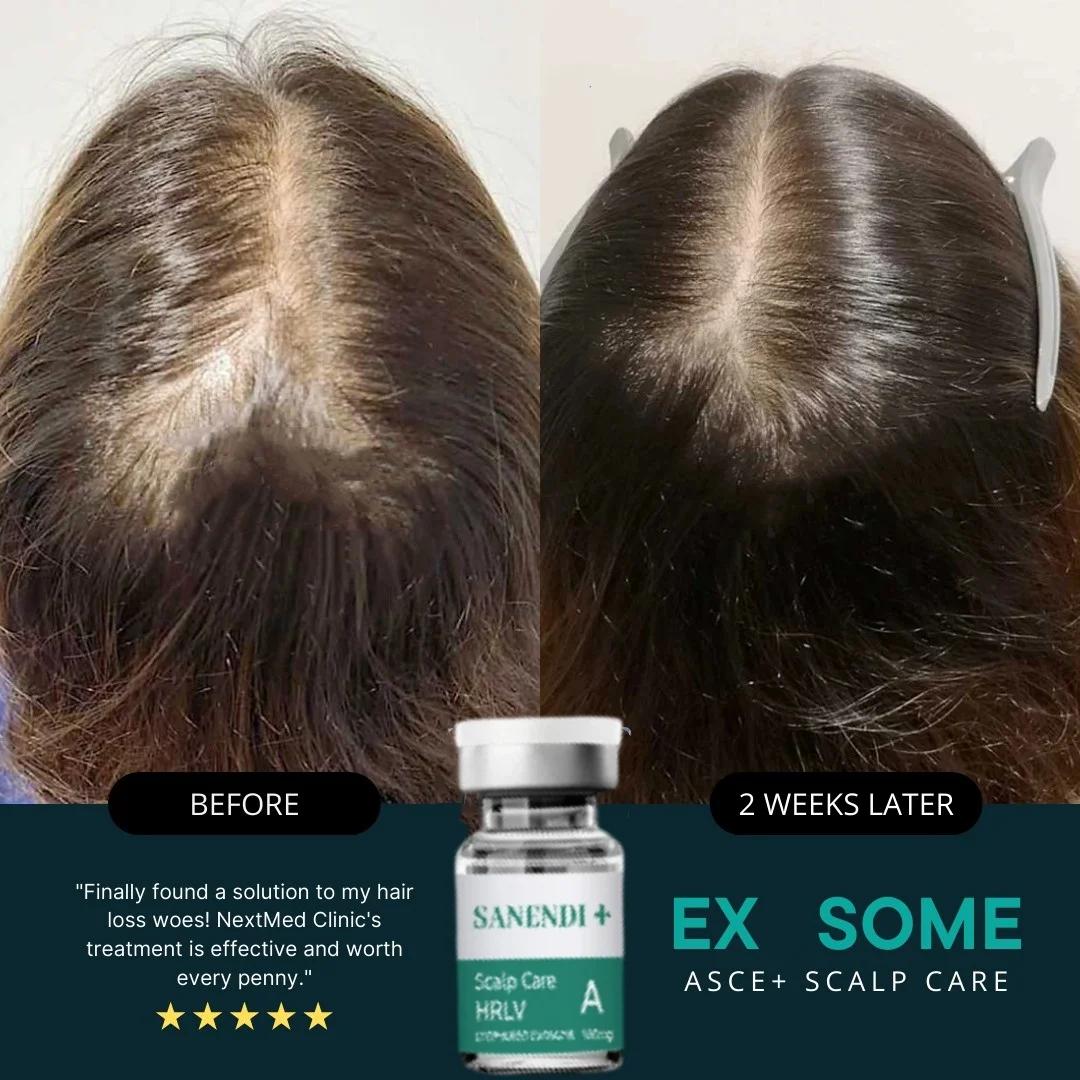 Exobio Meso sérum pour une croissance rapide des cheveux Anti perte de cheveux Kit ASCE + SCALP CARE